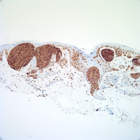 File:NKI-C3.melanoma.m.1.jpg