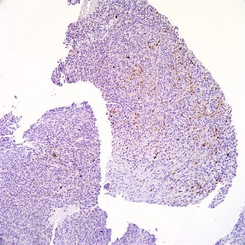 File:S100.MPNST.focal.2.jpg