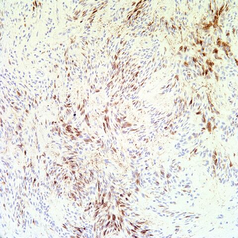 File:Desmin.mammary myofibroblastoma.2.jpg