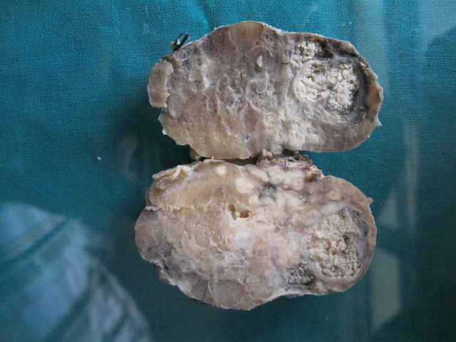File:Papillary ca. thyroid2.jpg