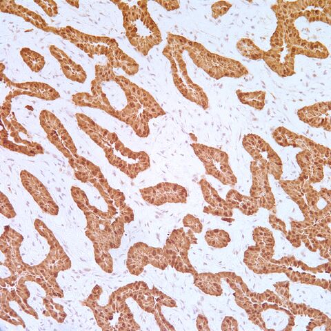 File:Calretinin.mesothelioma.1.jpg