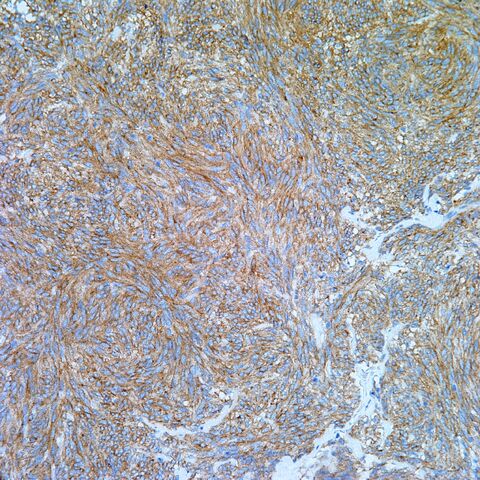 File:CD117.GIST.2.jpg