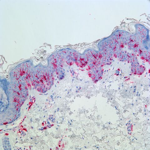 File:S100.langerhans.melanocytes.skin.jpg