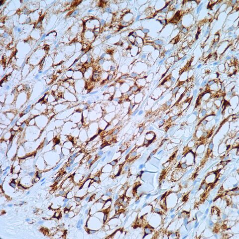File:HMB45.cutaneous pecoma.400x.2.jpg