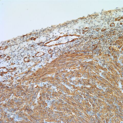 File:SMA.AML with cyst.4.jpg
