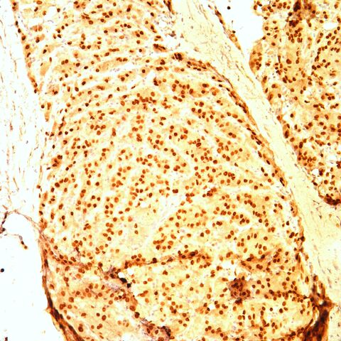 File:TFE3.alveolar soft part sarcoma.jpg