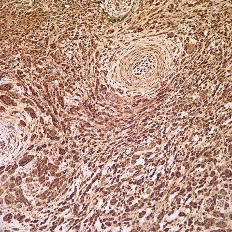 File:S100.desmoplastic neurotropic melanoma.8.jpg