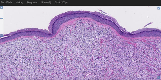 File:Primary Cutaneous PEComa shave.png