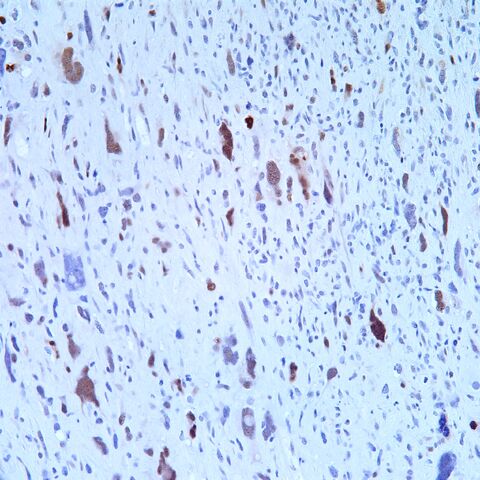 File:MDM2. Dedifferentiated Liposarcoma.jpg
