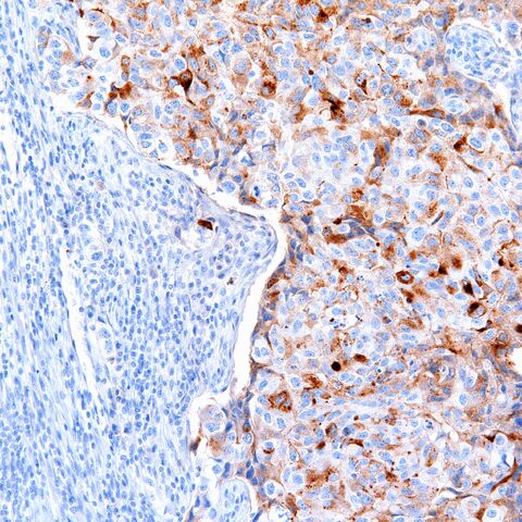 File:BRST2.high grade ductal carcinoma.maybe.200x.jpg