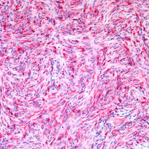 File:Factor XIIIa.13a.dermatofibroma.fibrous histiocytoma.2.jpg