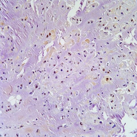 File:Brachyury.chordoma.8.jpg