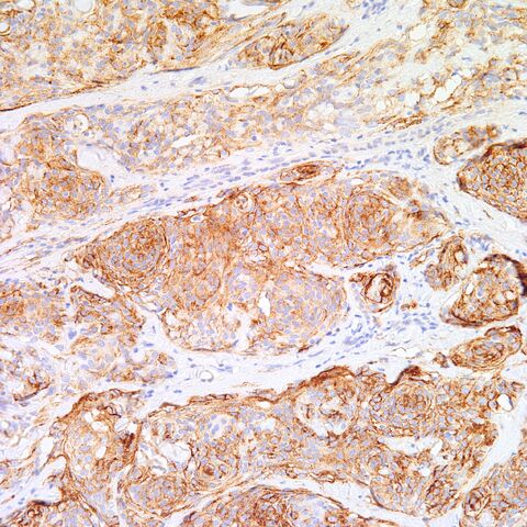 File:EMA.cutaneous meningioma.1.jpg