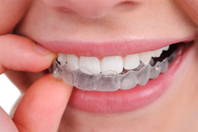 File:Dental Retainer.jpg