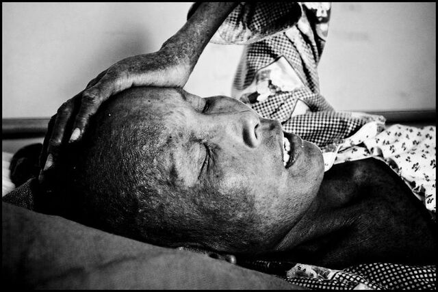 File:Cambodia AIDS Victim.jpg