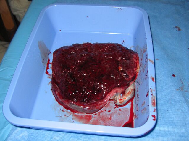 File:Human placenta uterine side.jpg