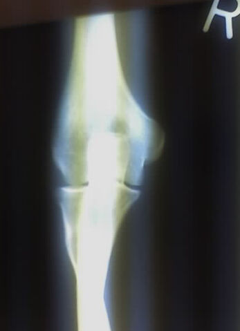 File:RightElbowXray.jpg