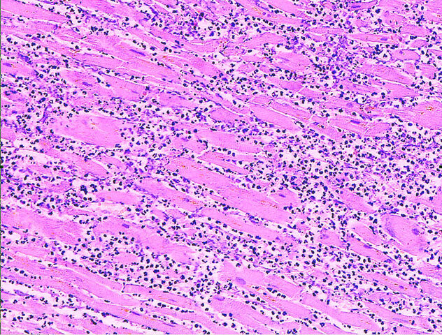 File:Myocardial infarct emmolition phase histopathology.jpg