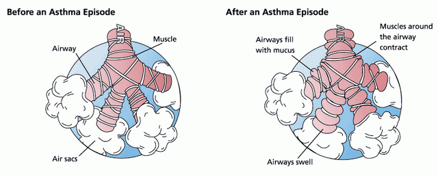 File:Asthma before-after.png