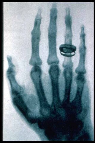 File:Roentgen-x-ray-von-kollikers-hand.jpg