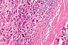 220px-Osteosarcoma - very high mag