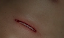 Dermis Tissue