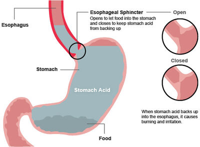 Understanding heartburn