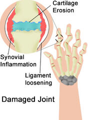 Arthritis