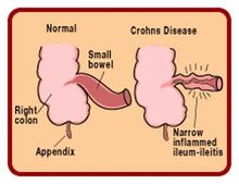 Symptoms-of-Crohn’s-disease