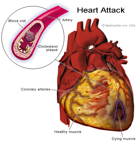 File:Heart attack.jpg