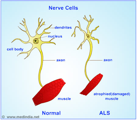 File:ALS.jpg