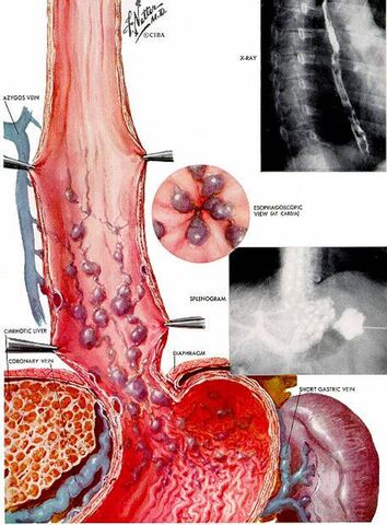 File:APEF 20081011052133 varizes do esofago.jpg
